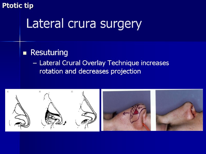>Lateral crura surgery Resuturing Lateral Crural Overlay Technique increases rotation and decreases projection Ptotic